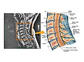 Bulging discs in the cervical spine