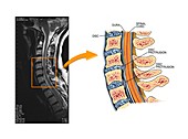 Protruding discs in the cervical spine