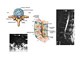 Slipped disc in the lumbar spine