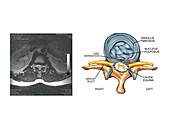 Slipped disc in the lumbar spine