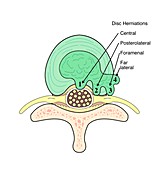 Types of herniated intervertebral discs