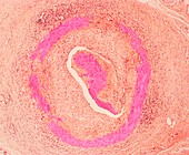 Temporal arteritis,light micrograph