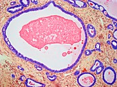 Uterus adenofibroma,light micrograph