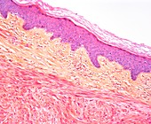 Leiomyosarcoma of skin. light micrograph