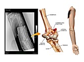 Comminuted fracture of the elbow