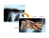 Fractured collar bone