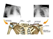 Internal fixation of broken collar bones