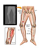 Fractures of femur and tibia