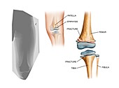 Type II Salter fracture in the knee