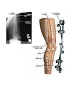 External fixation of fractured femur