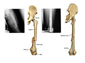 Internal fixation of fractured femur