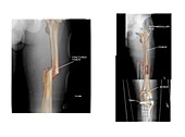 Internal fixation of fractured femur
