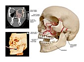 Multiple facial skull fractures