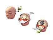 Skull fracture surgery,artwork