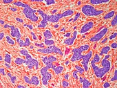 Breast cancer,light micrograph