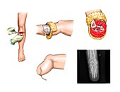 Below-knee leg amputation
