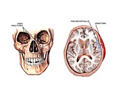 Facial fractures and brain injuries