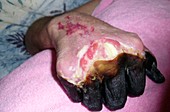 Dry gangrene caused by the plague
