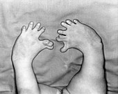 Thalidomide deformity