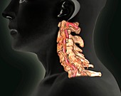 Arthritis of the neck,3D CT scan