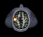 Brain tumour,fMRI scan