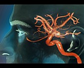 Aneurysm,3D CT angiogram