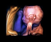 Foetus,3D ultrasound scan
