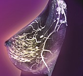 Breast nerve damage,MRI scan
