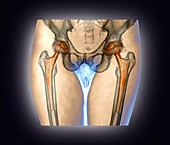 Double hip replacement,3D CT scan