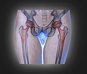 Double hip replacement,3D CT scan