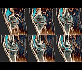 Knee sprain,MRI scans