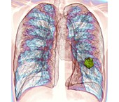 Lung cancer,3D CT scan