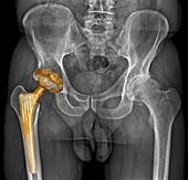 Hip replacement,3D CT scan