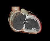 Artificial heart valve,3D CT scan
