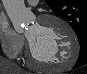 Heart valve disease,CT angiogram