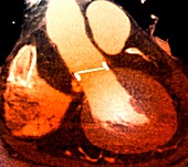 Artificial heart valve,CT scan