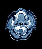 Salivary gland stone,CT scan