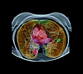 Lung cancer,CT scan
