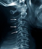 Forestier disease,X-ray