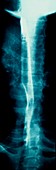 Healthy oesophagus,X-ray