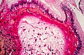 Stomach ulcer,light micrograph