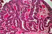Colon cancer,light micrograph