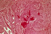 Oesophageal cancer,light micrograph