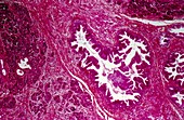 Pancreatic cancer,light micrograph