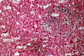 Liver sarcoidosis,light micrograph