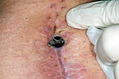Infected spinal surgery wound