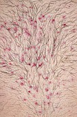 Folliculitis after chest waxing