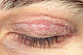 Eczema on eyelid