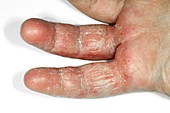 Eczema on fingers of a young boy