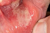 Extensive mouth ulcer